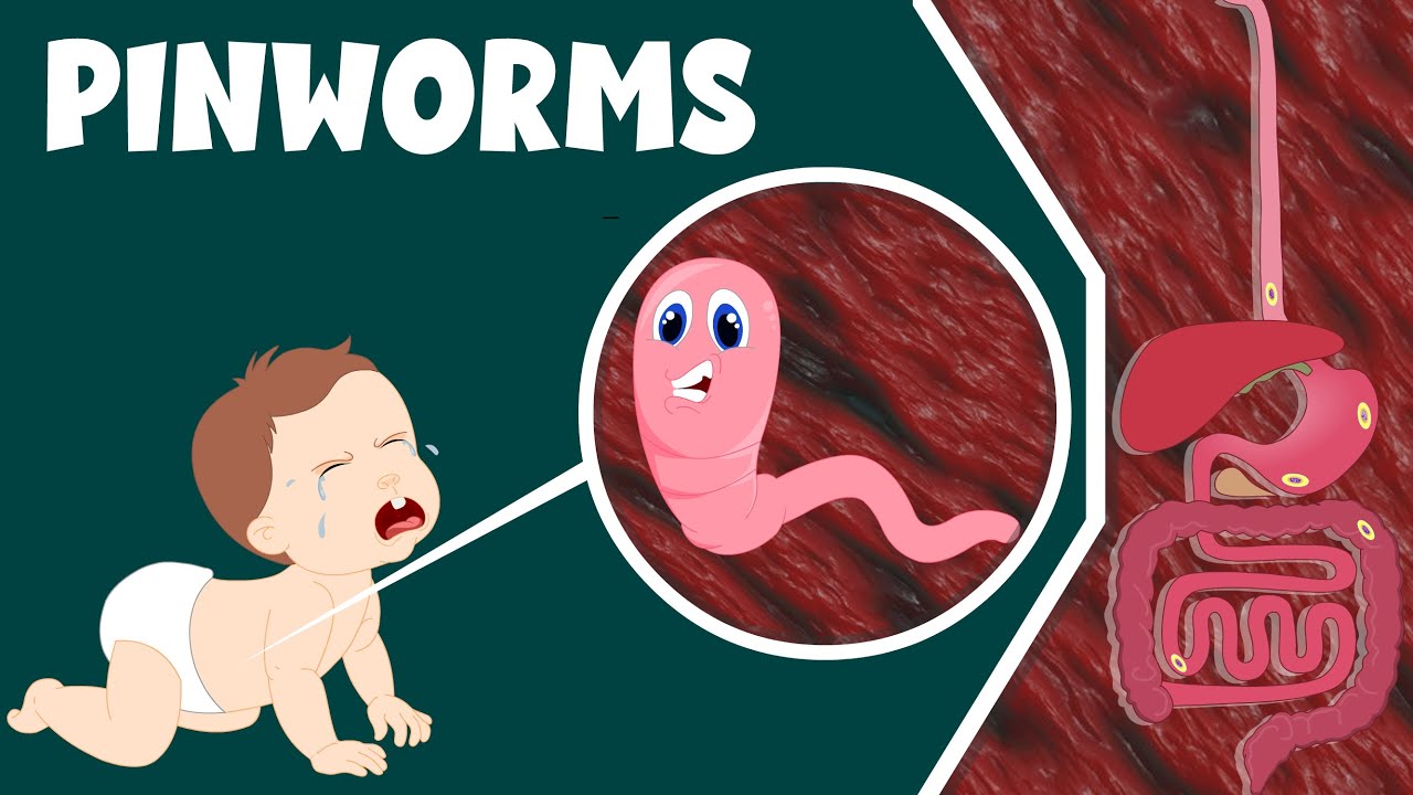 How Pinworm Treatments Support Long-Term Prevention